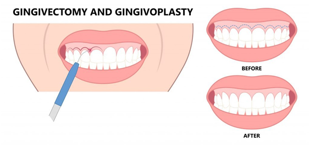 Gingivectomy Smile