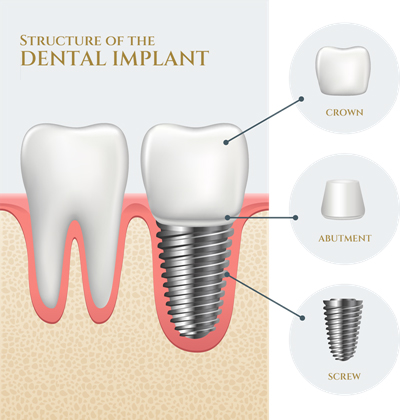 Single Tooth Implant