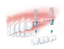 Multiple Teeth Implant