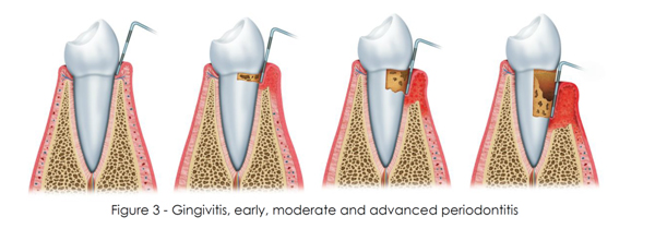 Periodontitis