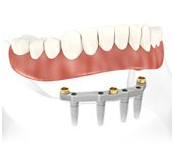 Removable Teeth Replacement on Implants