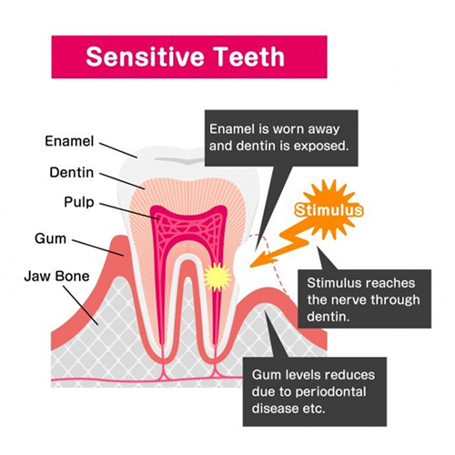 Sensitive Teeth